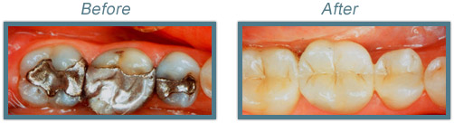 fillings