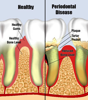 periodontal treatment