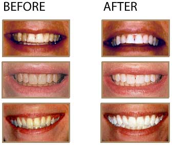 teeth whitening