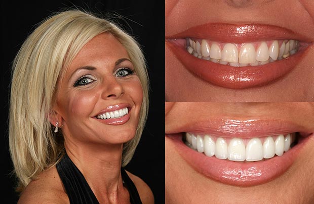 veneers